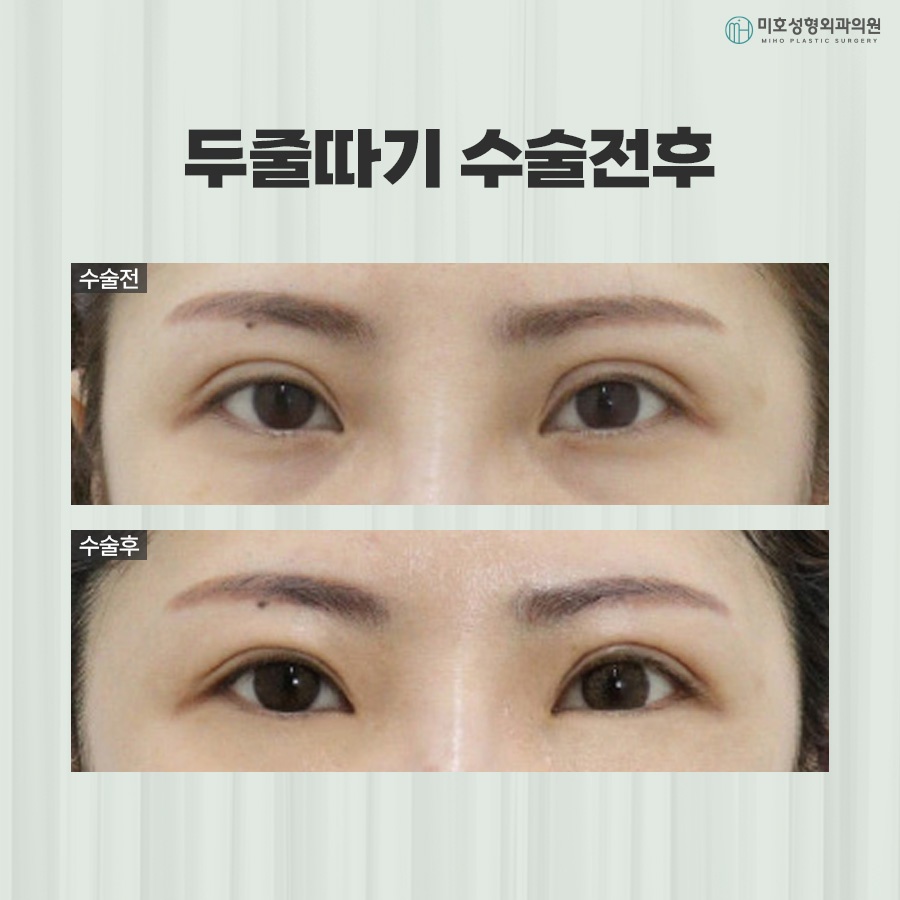 Differences Between One-Line and Two-Line Correction and Causes of Sausage Eyes image 8