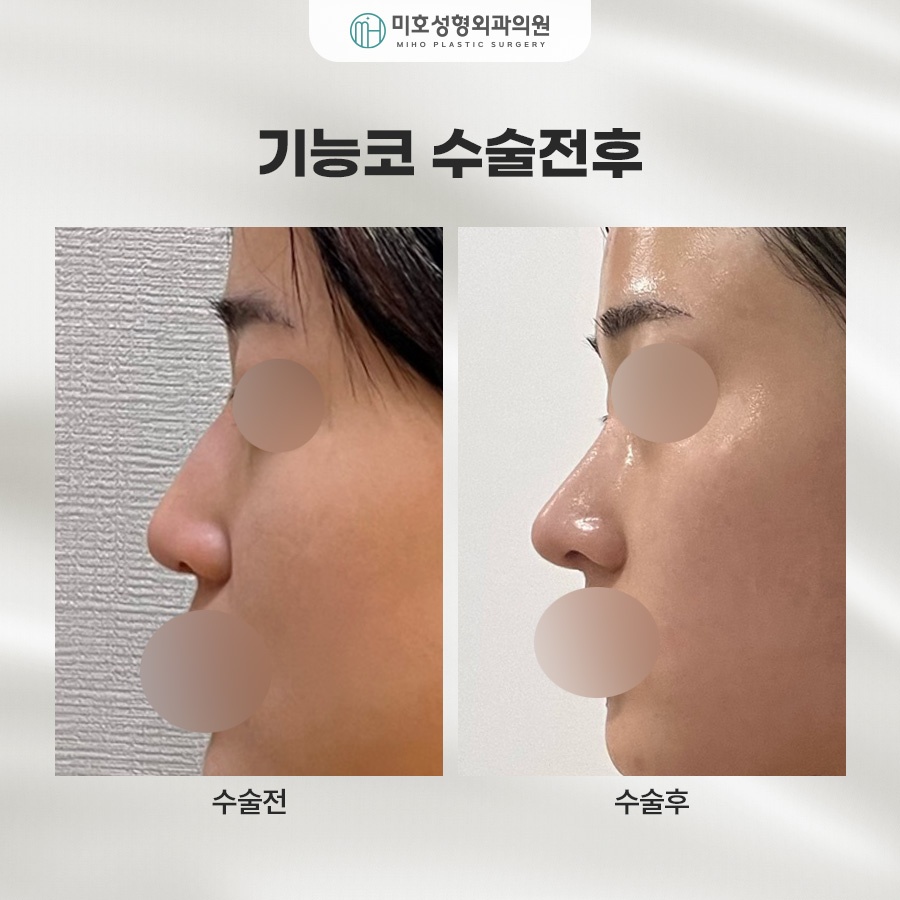 기능코 교정의 중요성 관련 이미지 8