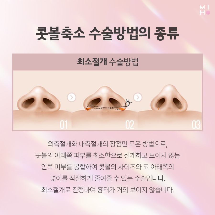 How Alar Reduction Surgery Is Performed and What to Expect in the Future image 5