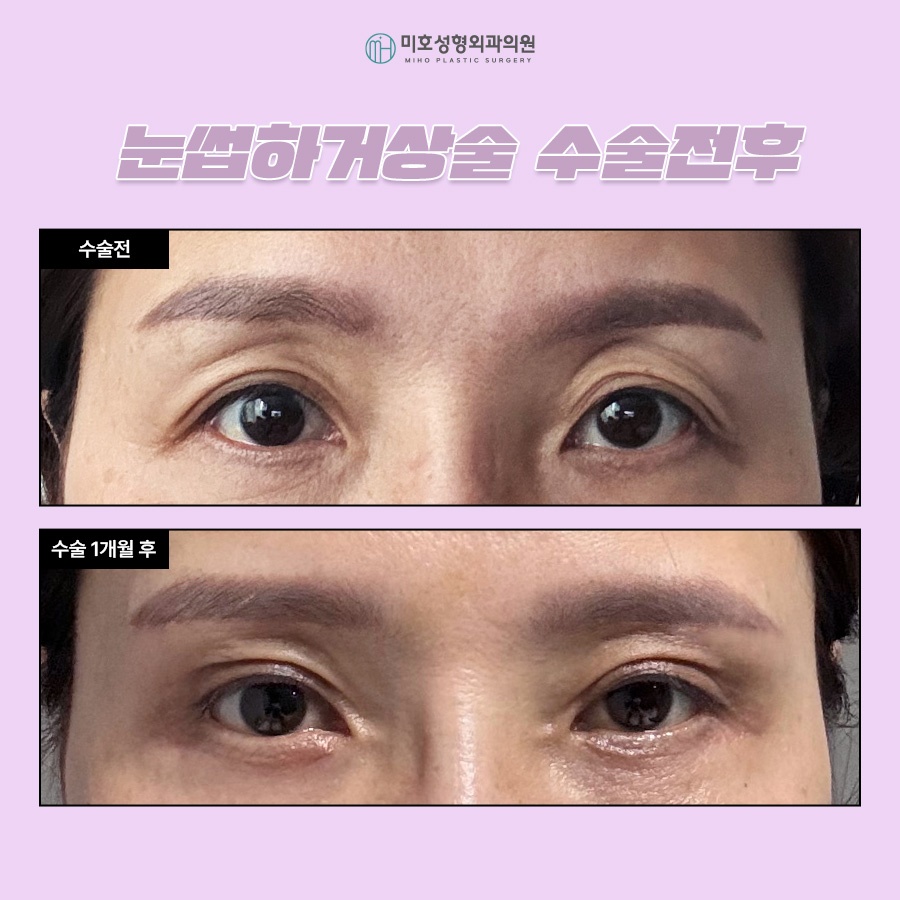 눈썹하거상술 비용과 후기 흉터 궁금하다면 관련 이미지 7