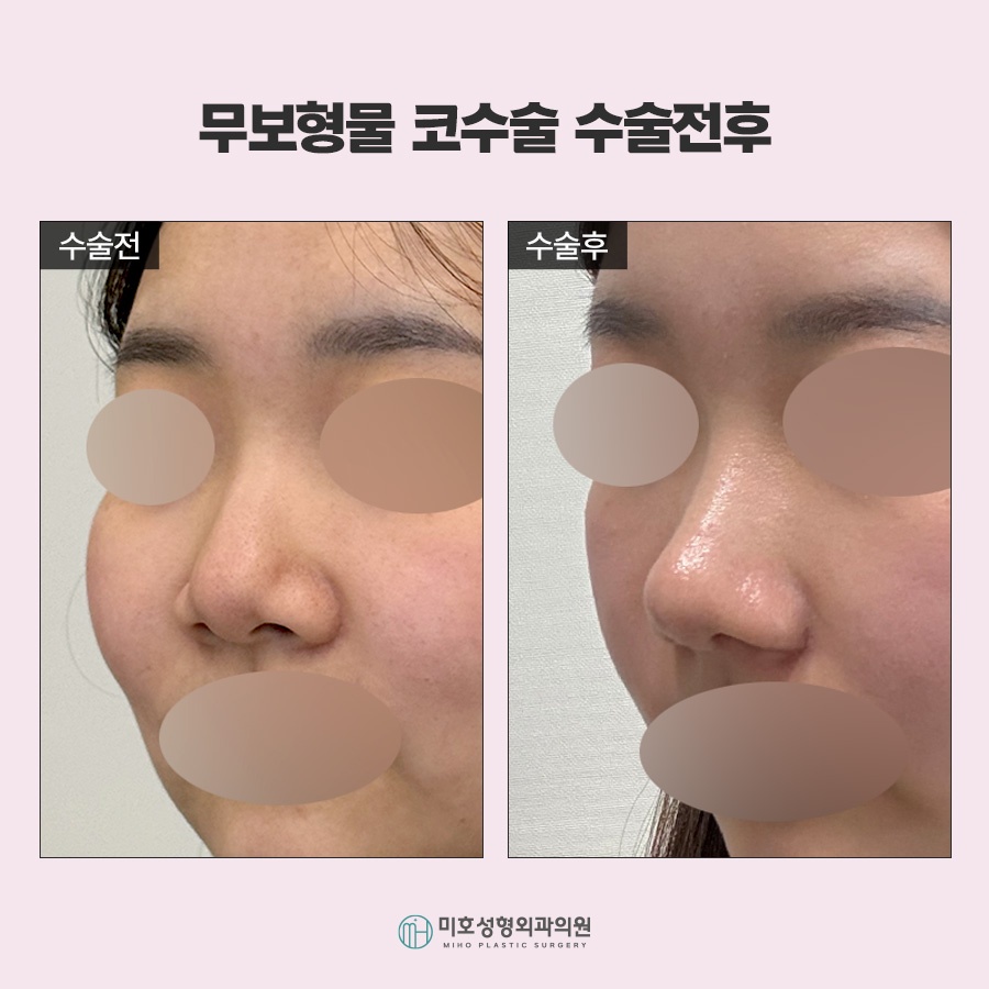 무보형물코수술 자연스러운 코라인을 위한 재료 선택과 확인사항 관련 이미지 8