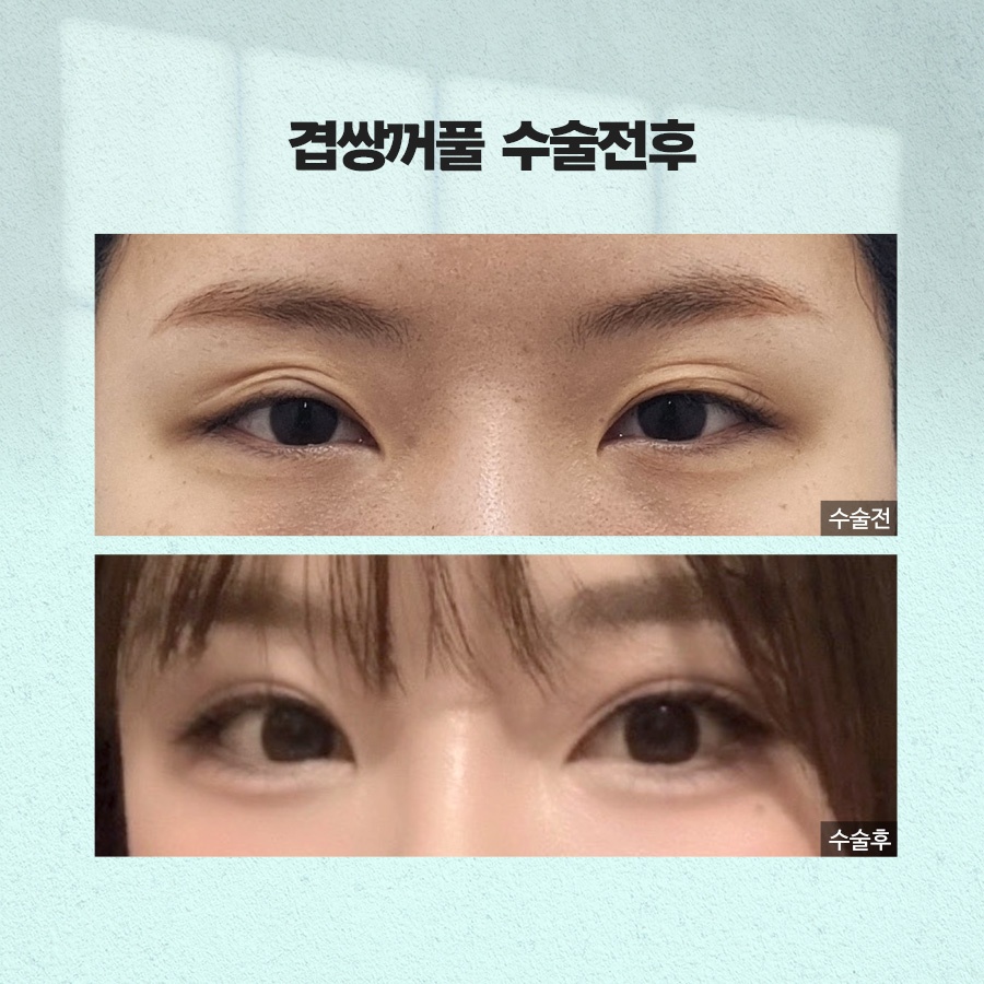 겹쌍꺼풀 생기는 이유와 없애는 방법까지 관련 이미지 9