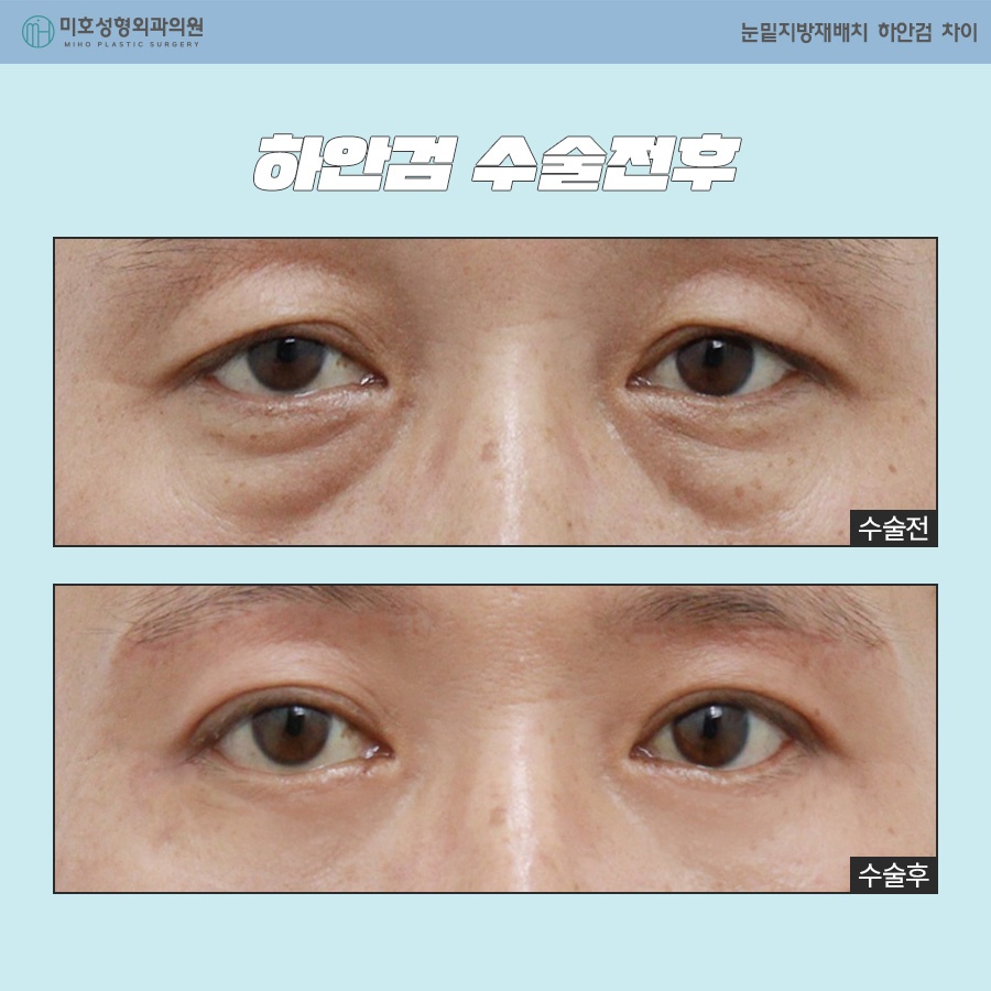 How to Choose Between Under-Eye Fat Repositioning and Lower Blepharoplasty image 9