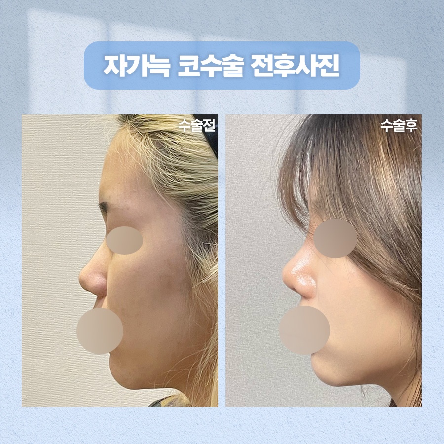 자가늑코수술 재료 특성과 회복 과정 관련 이미지 10