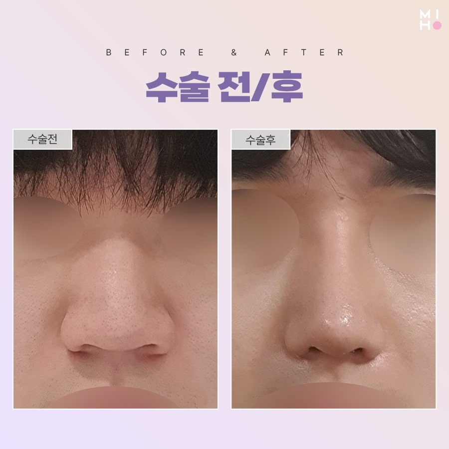 Refining a Bulbous Nose for a Sophisticated Look image 8