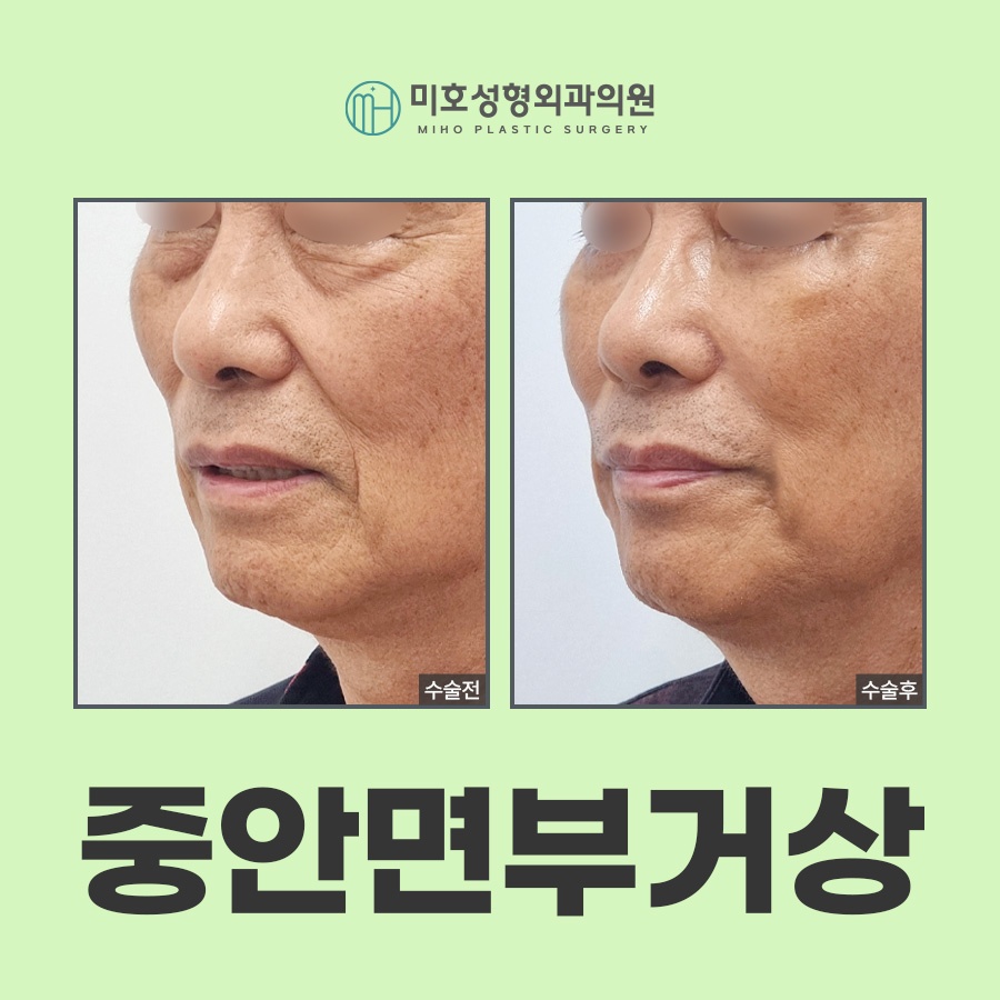 중안면거상 노화 증상에 주목하여 관련 이미지 1