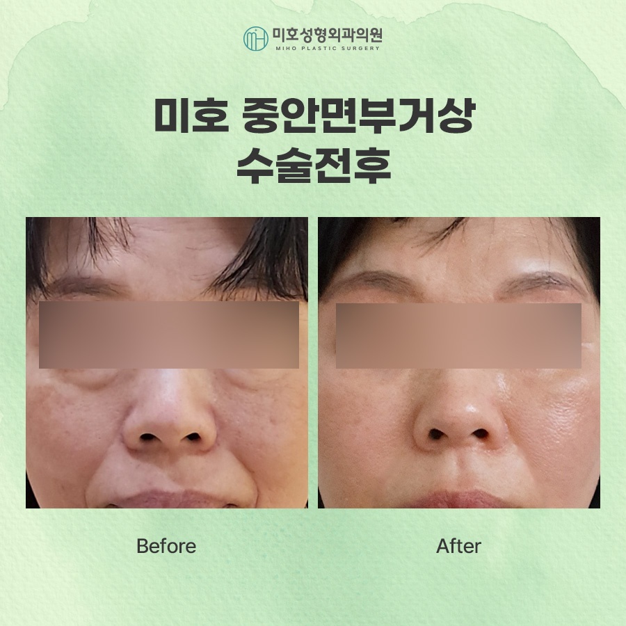 중안면거상 노화 증상에 주목하여 관련 이미지 8