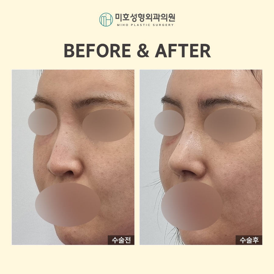 Adjusting the Approach According to the Type of Nostril-Lowering Procedure image 8