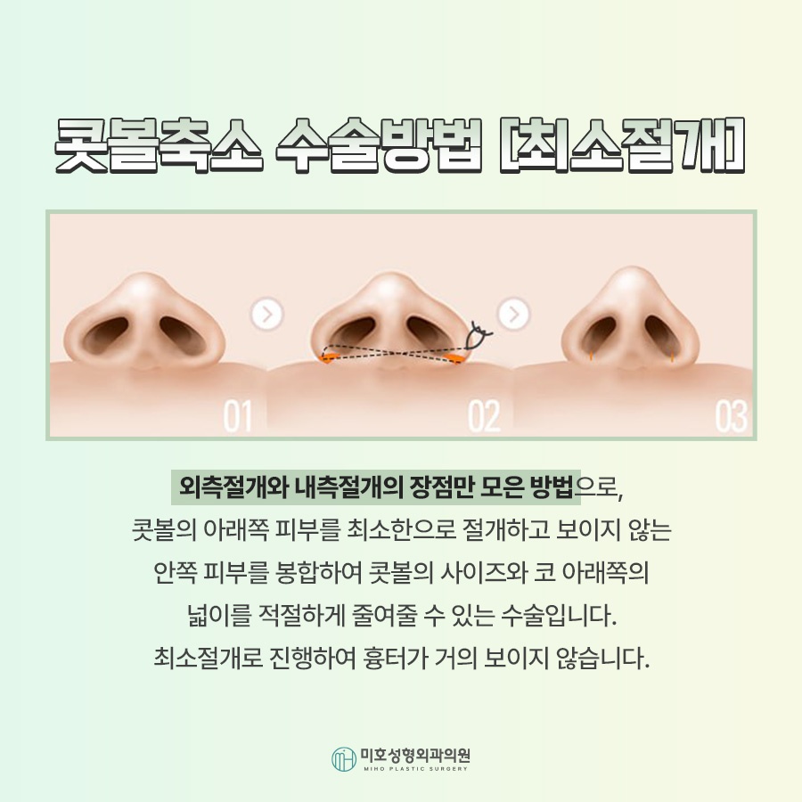 A Successful Guide to Male Alar Reduction for a Refined Appearance image 6