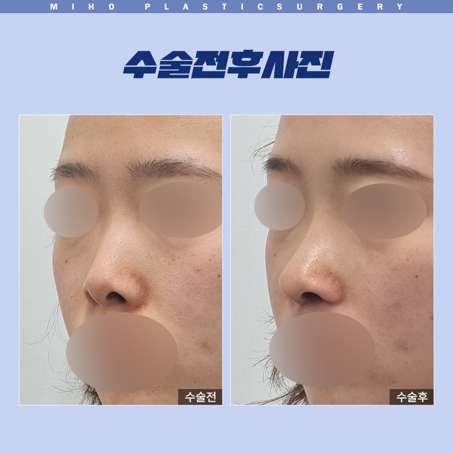Correcting a Dragon Nose with Nostril-Lowering Surgery image 6