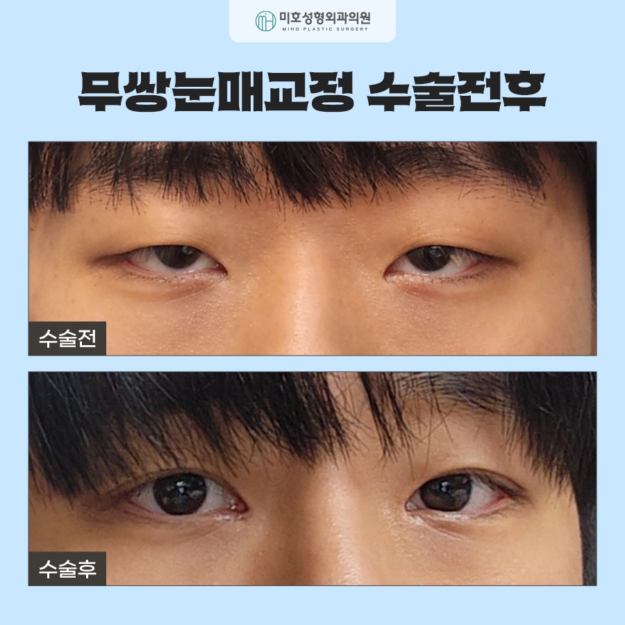 무쌍눈매교정 전후 차이를 비교해보고 관련 이미지 9