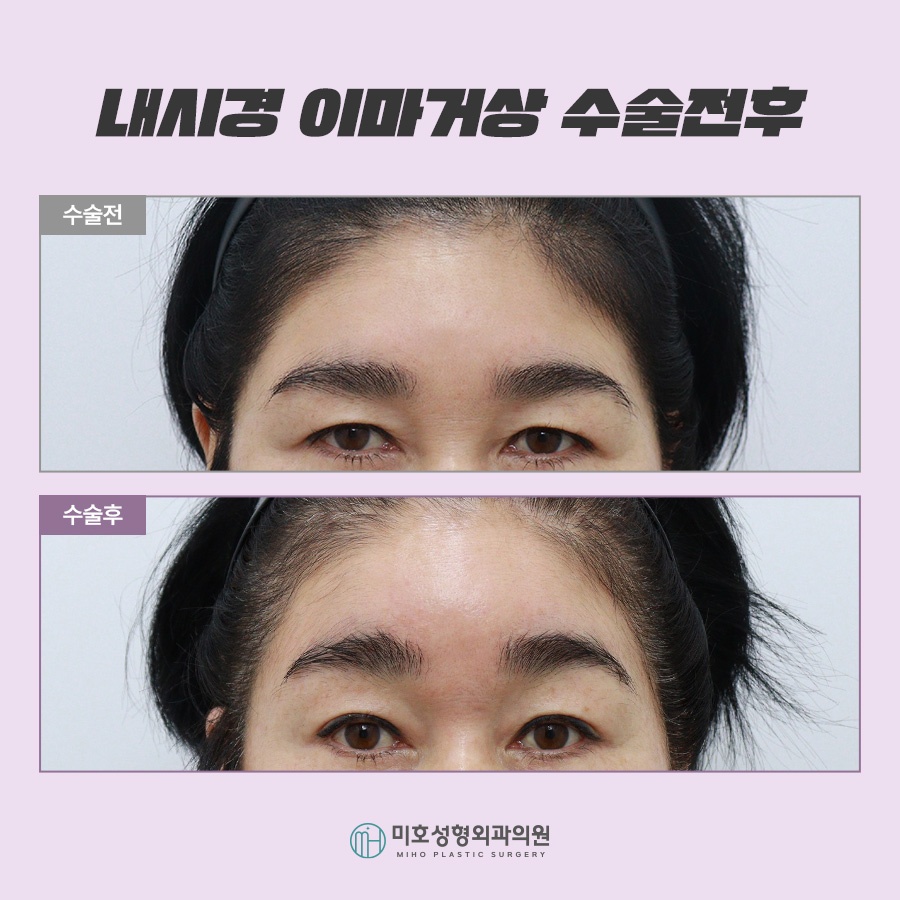 Forehead Lift Surgery Review: Tailored to Sagging Areas image 10