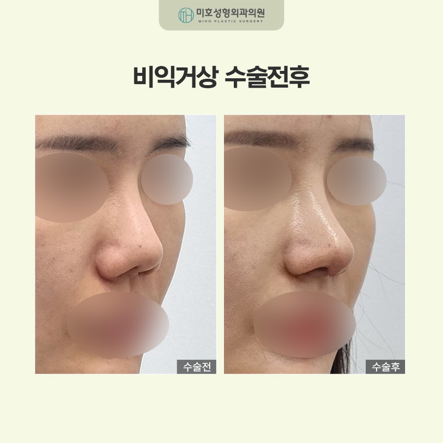 비익거상으로 예쁜 코 만드는 비결 총정리 관련 이미지 9