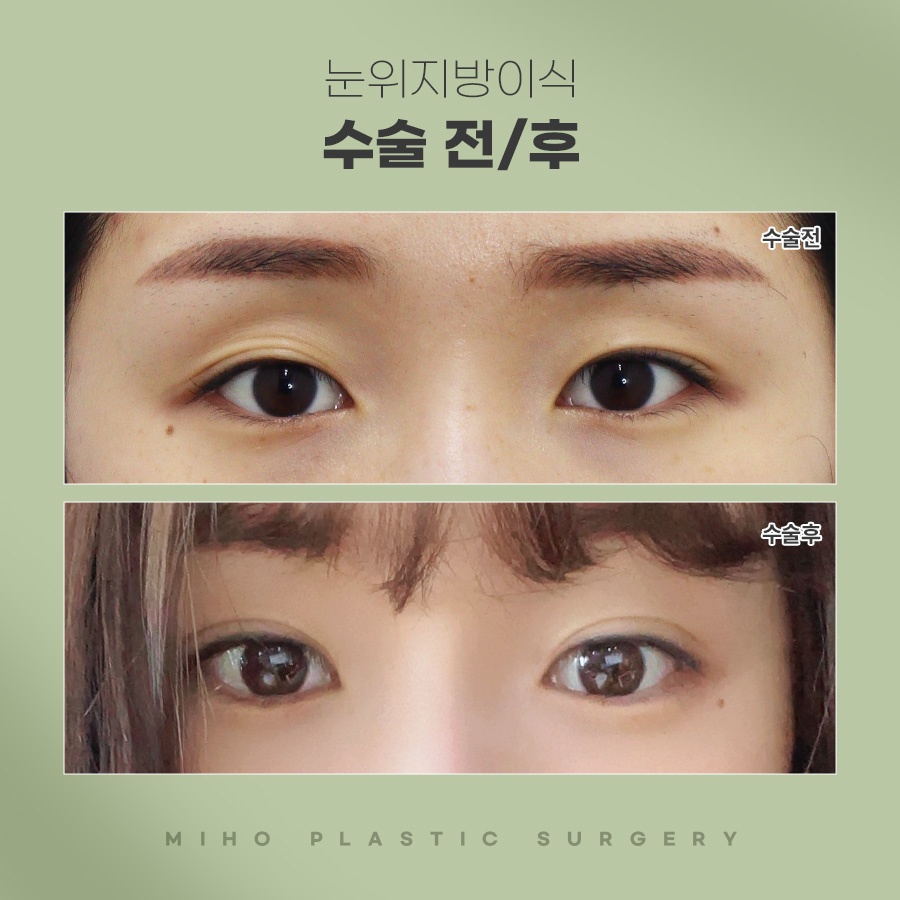 눈두덩이꺼짐 때문에 고민이라면 관련 이미지 6