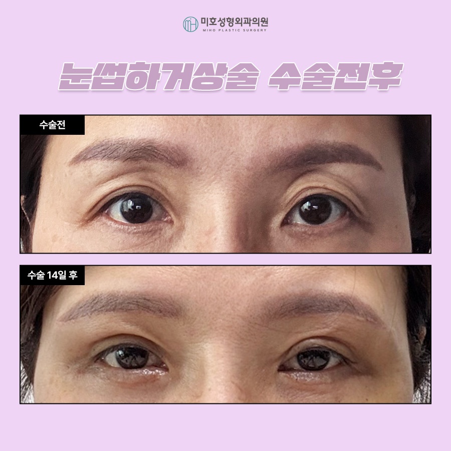 눈썹하거상술 비용과 후기 흉터 궁금하다면 관련 이미지 6