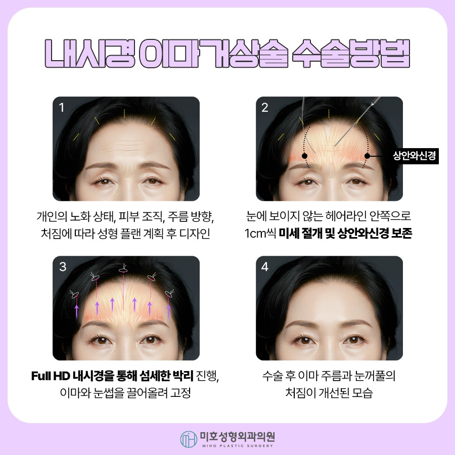 Why Choose Thread Lifting for a Brow Lift image 5