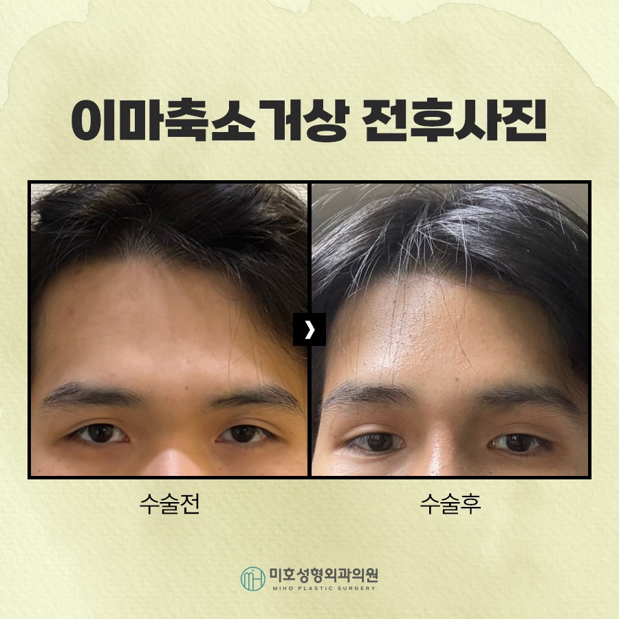 이마축소거상 부작용 더는 방법 관련 이미지 7