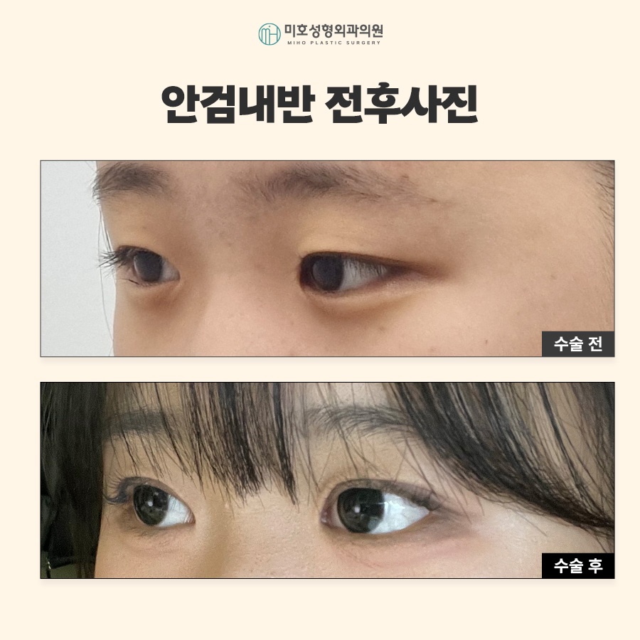 안검내반수술 눈물과 자극이 반복된다면 관련 이미지 7