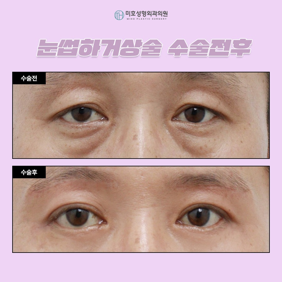 눈썹하거상술 비용과 후기 흉터 궁금하다면 관련 이미지 8