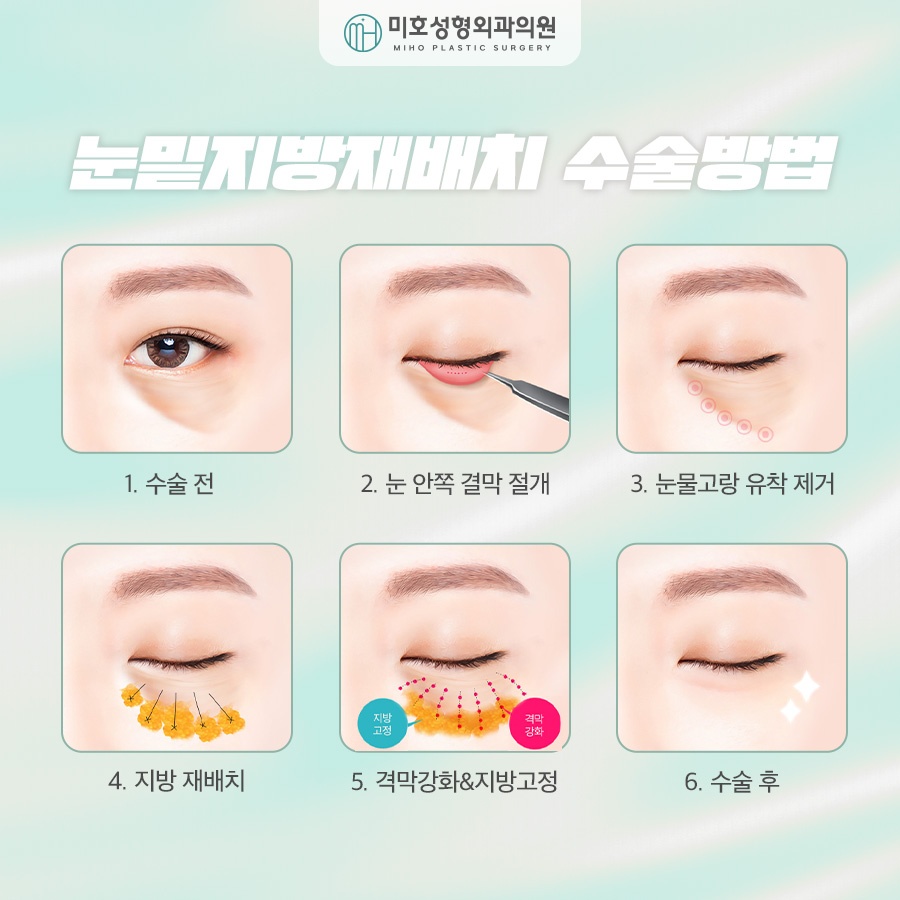 눈밑지방재배치후기 비교분석 하길 원한다면 관련 이미지 5