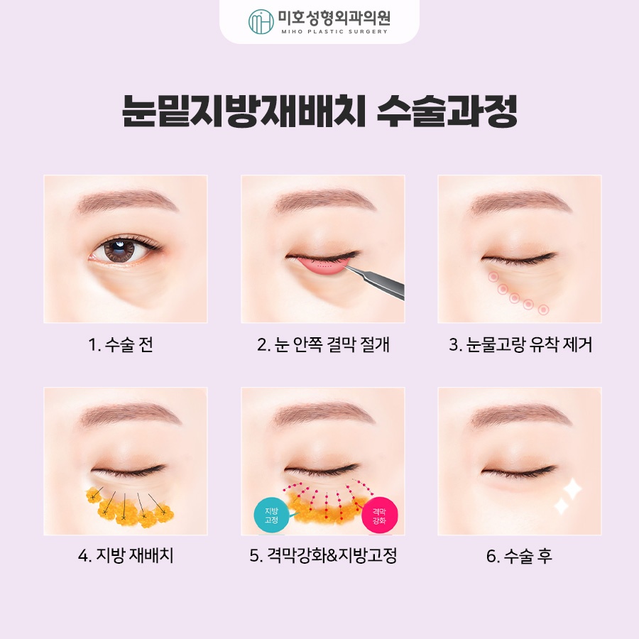 To Learn About Under-Eye Fat Graft Reviews, Methods, Swelling, and Recovery image 6