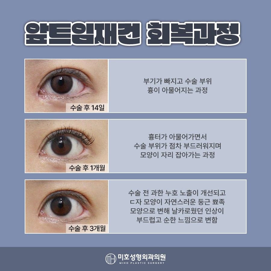앞트임재건 미세함의 차이로 관련 이미지 7