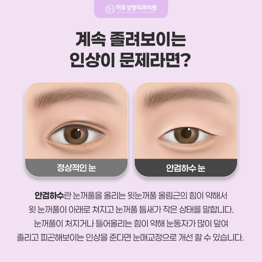 눈매교정술 힘 조절이 필요하다면 관련 이미지 2
