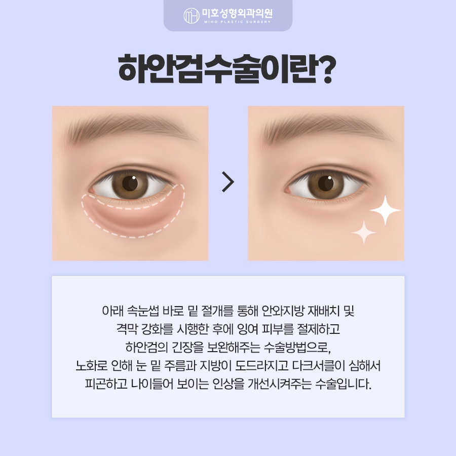 하안검수술 아래쪽 변화가 고민이라면 관련 이미지 2