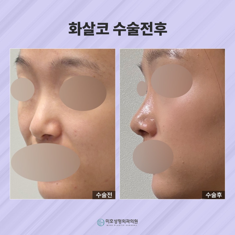 화살코 교정 방법 및 관리수칙 관련 이미지 6