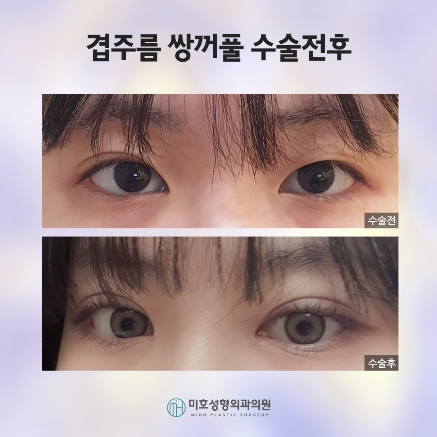 겹쌍꺼풀 깔끔하게 정돈하려면 관련 이미지 9