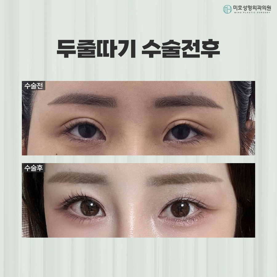 Differences Between One-Line and Two-Line Correction and Causes of Sausage Eyes image 9