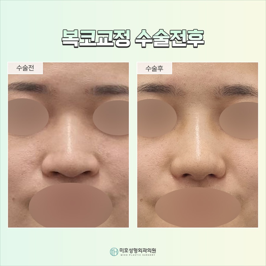 Nose Tip Refinement for a More Defined Impression image 10