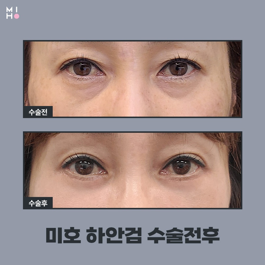 하안검수술 이미지 변신도 안전하게 관련 이미지 6