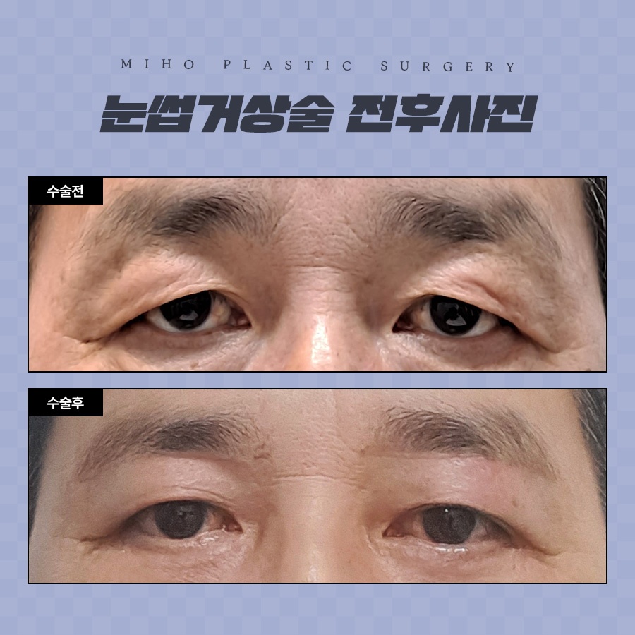 눈썹거상술 잘못된 오해와 장단점 관련 이미지 6