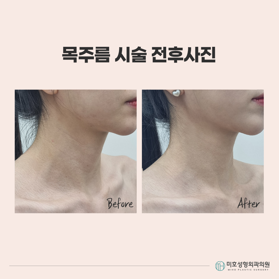 목주름시술 선명한 가로선이 고민이라면 관련 이미지 8