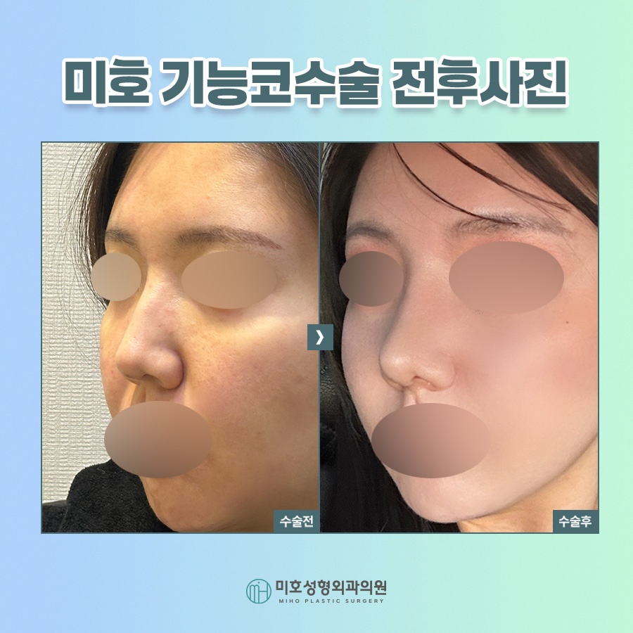 비밸브재건술 진행시 고려할 부분 관련 이미지 8