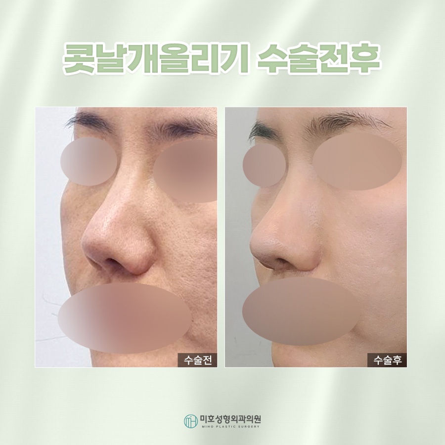콧날개올리기 처진 코 교정 관련 이미지 8