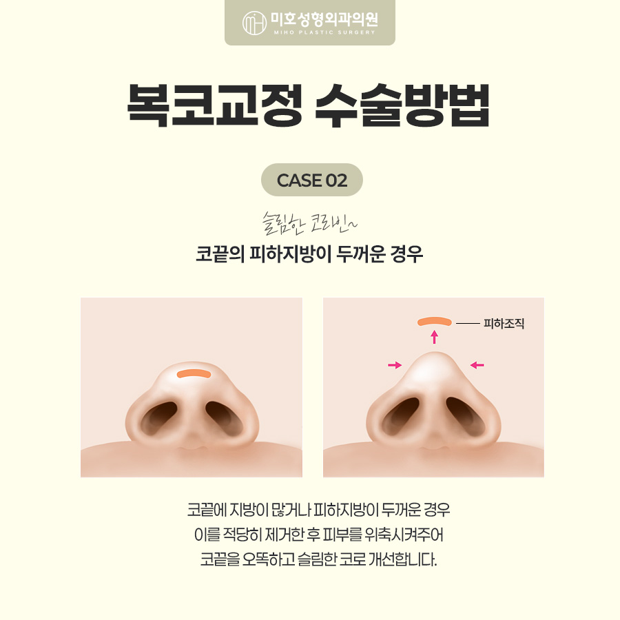 복코교정이란? 복코 원인부터 수술방법, 회복기간까지 알아보기 관련 이미지 5