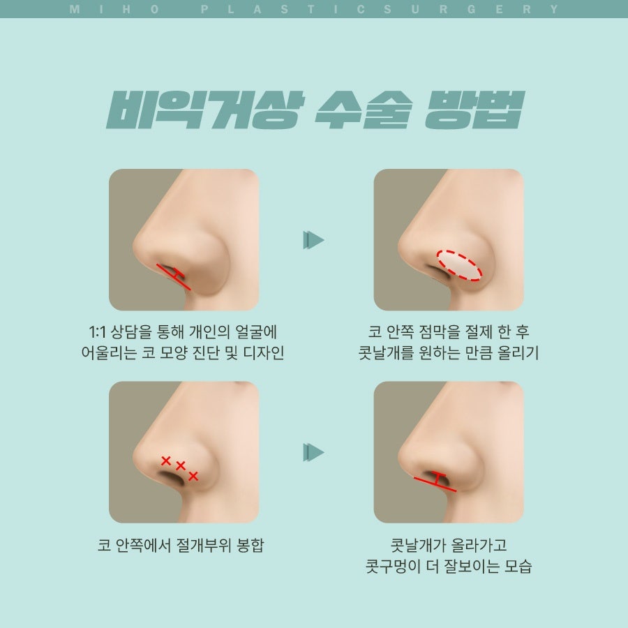 Creating a Naturally Refined Nose with an Alar Lift image 19
