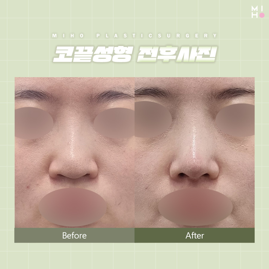 코끝성형 오똑하고 자연스럽게 관련 이미지 6