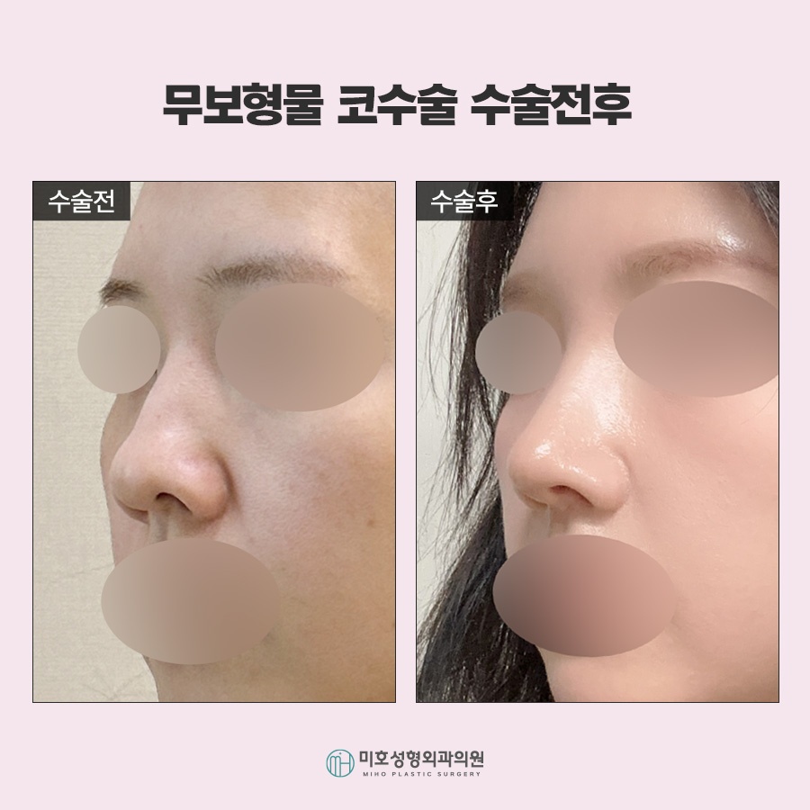 무보형물코수술 자연스러운 코라인을 위한 재료 선택과 확인사항 관련 이미지 9
