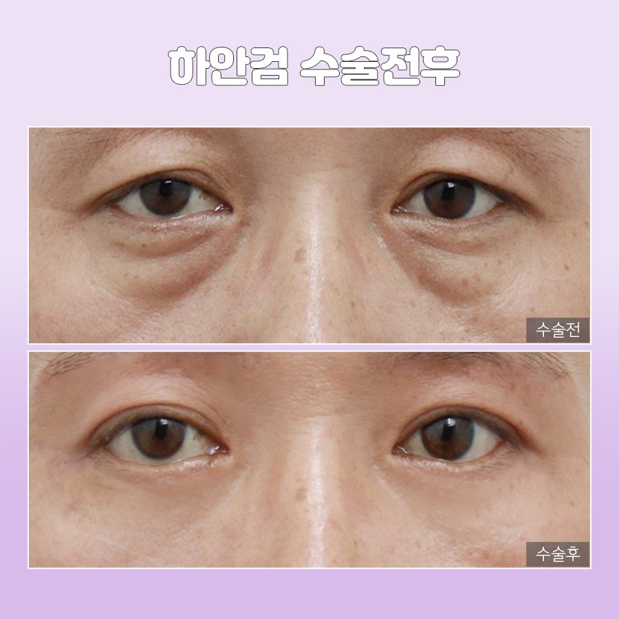 미호 시그니처 눈밑성형 지방재배치 눈매 개선 관련 이미지 10