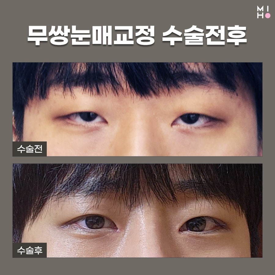 무쌍눈매교정 상황에 따른 개선법 관련 이미지 21