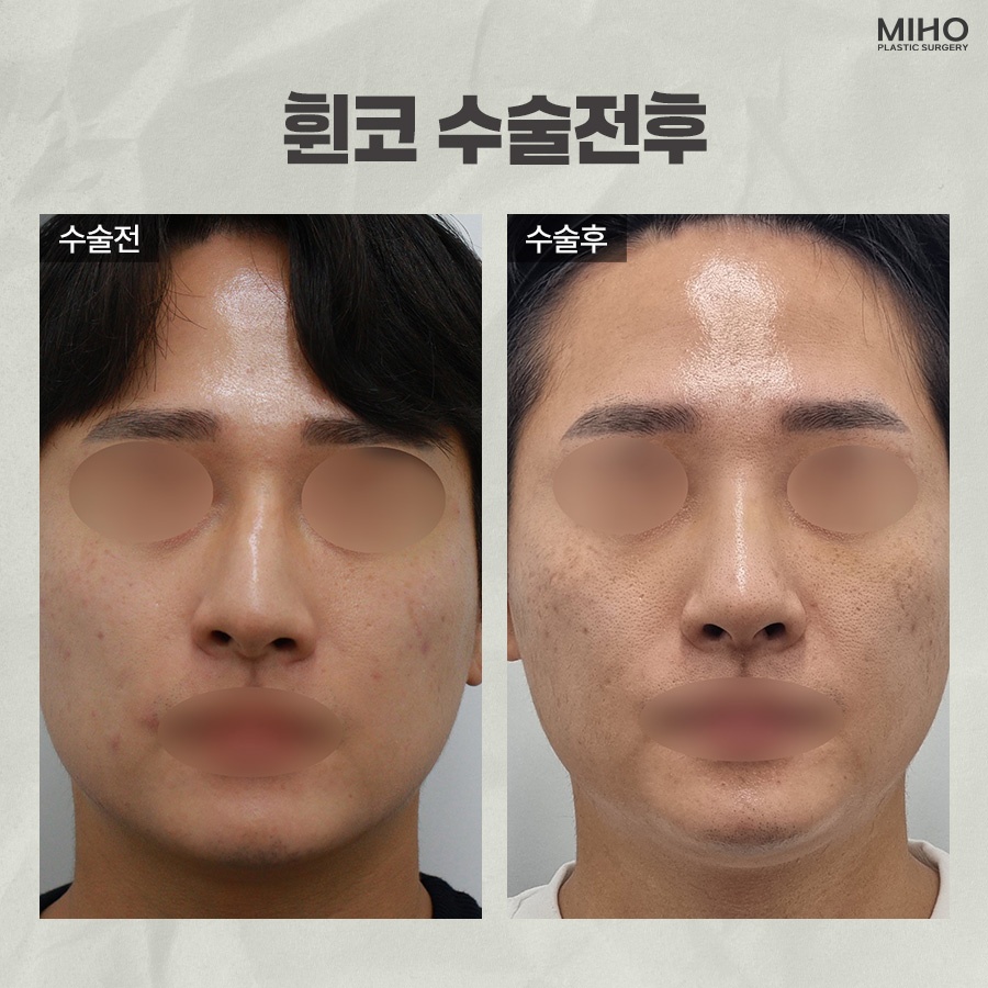 Experiencing the Difference in Crooked Nose Surgery image 9