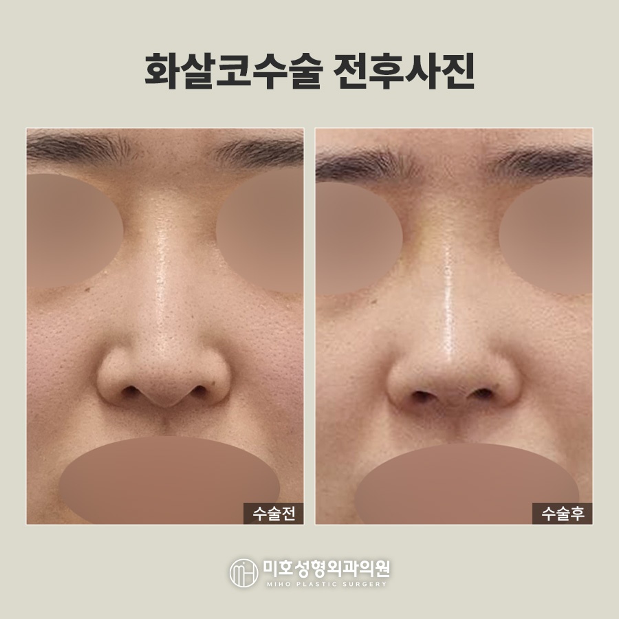 화살코 처진 코끝 교정으로 세련된 인상 만들기 관련 이미지 8