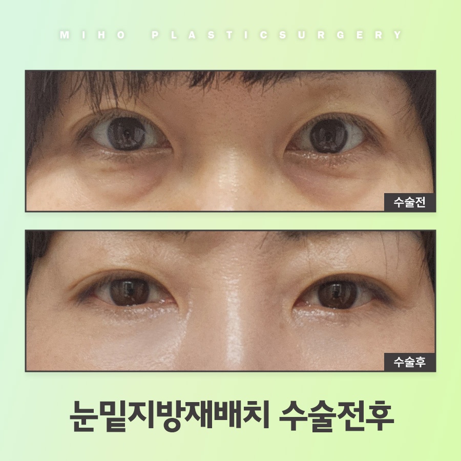 눈밑지방재배치 고민에 맞게 개선하며 관련 이미지 10
