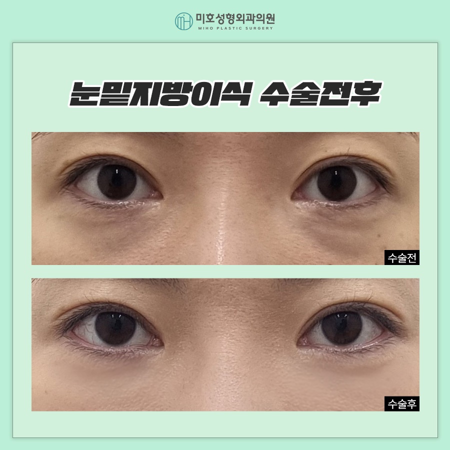 일반 눈밑지방이식과 나노지방이식의 차이점 관련 이미지 9
