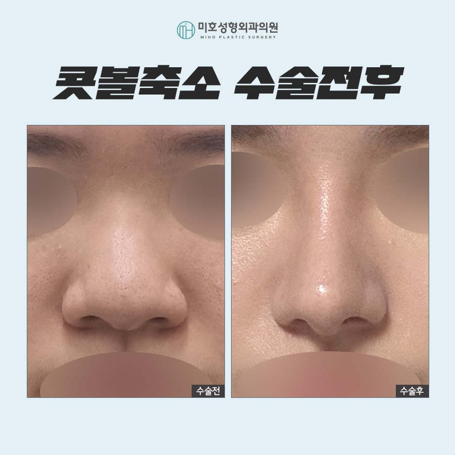 A Systematic Approach to Alarplasty image 10