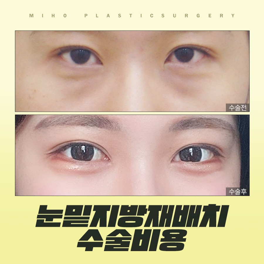 눈밑지방재배치수술비용 내게 맞는 수준은 관련 이미지 1
