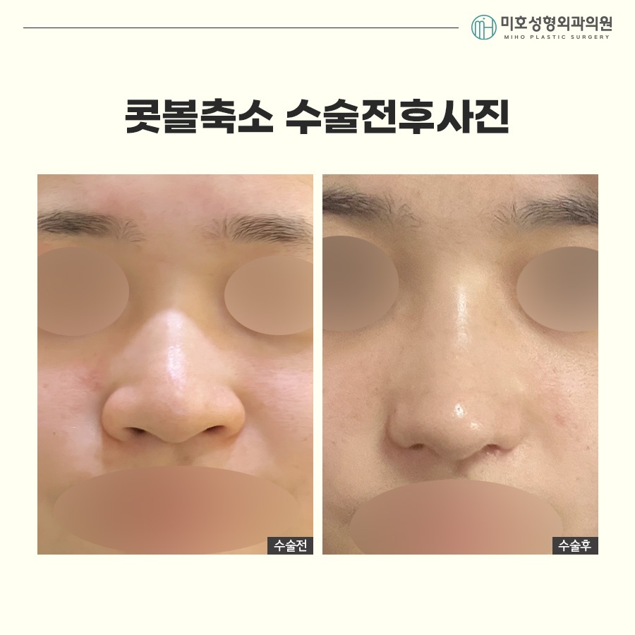 How to Make Your Nostrils Look Smaller: Considering Facial Harmony image 8